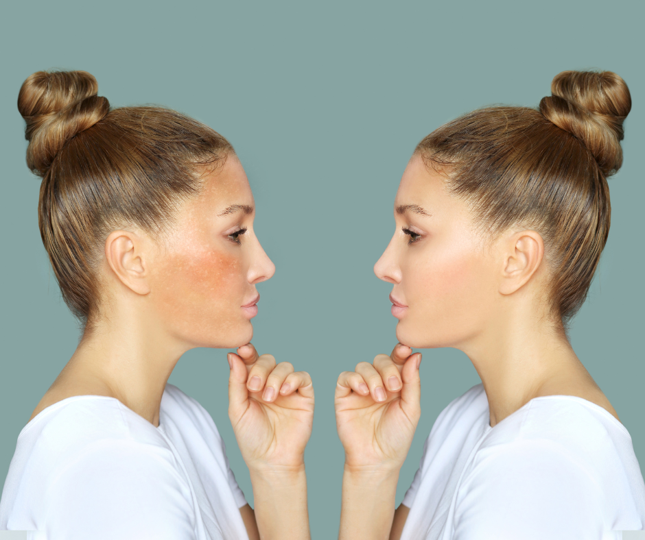 hyperpigmentationimg